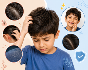 Dandruff in Kids: Why It Happens & Simple Ways to Keep Your Child’s Scalp Healthy